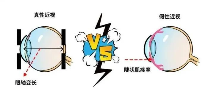 真性近视与假性近视