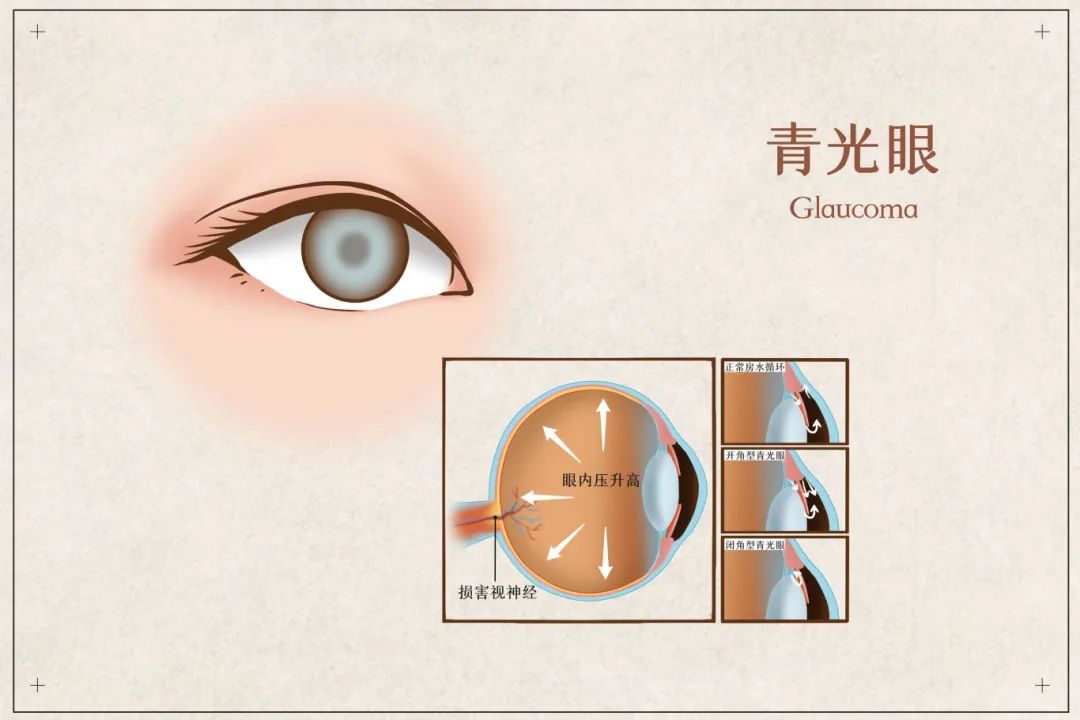 青光眼