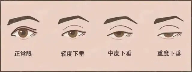 上睑下垂表现