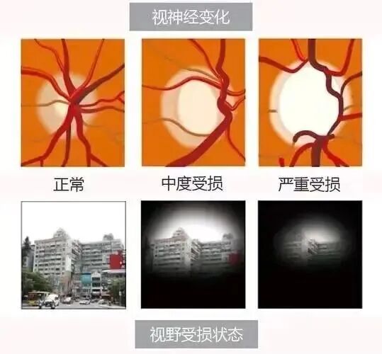 青光眼对视力和视神经的损害是不可逆的
