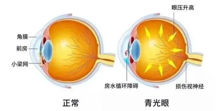 青光眼对视力和视神经的损害是不可逆的
