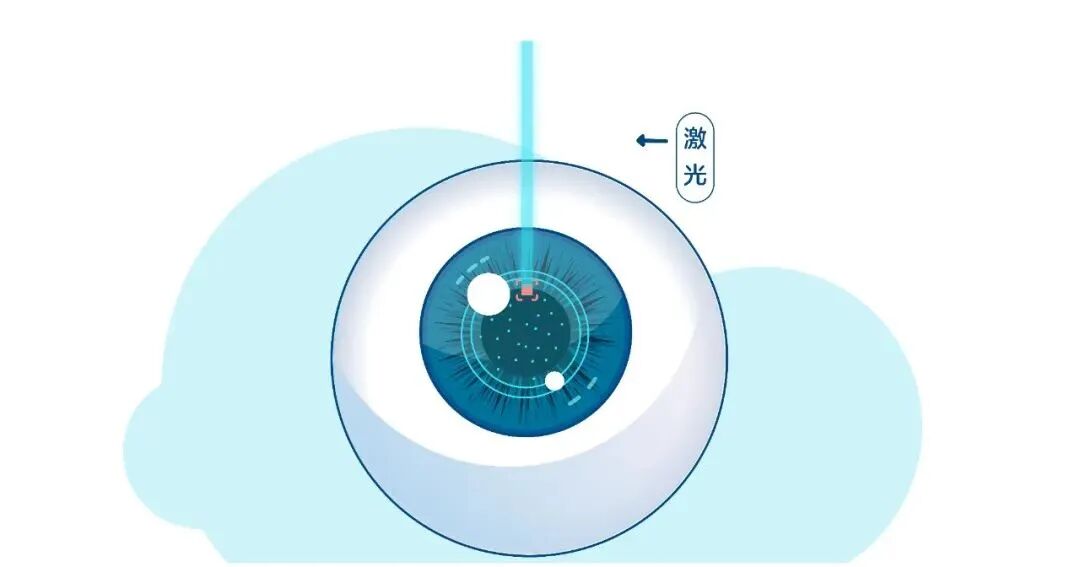 激光类近视手术