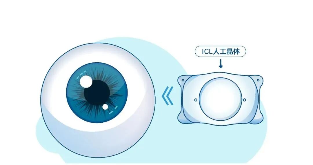 ICL晶体植入术