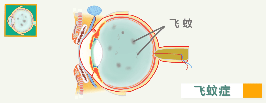 飞蚊症