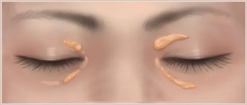 合肥华厦名人眼科|眼睛出现这几个信号，可能是血脂在“报警”！千万别忽视！