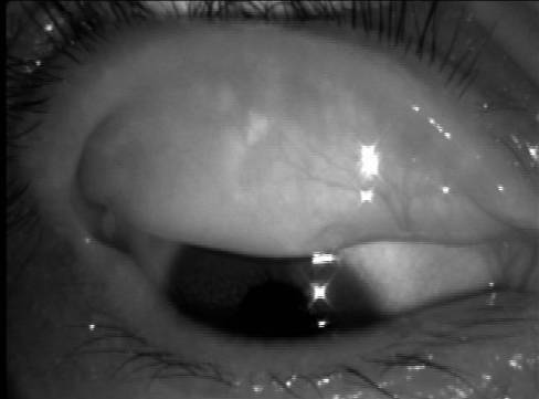 睑板腺全部消失