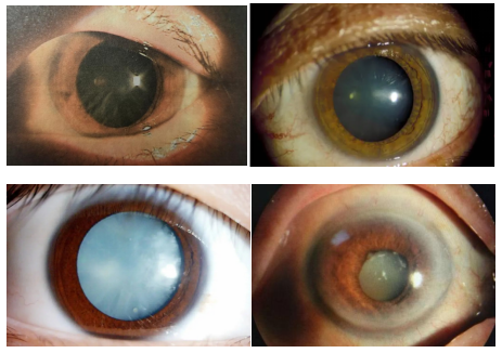 白内障的初发期、膨胀期、成熟期和过熟期