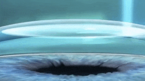 角膜激光近视手术