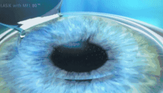 激光角膜近视手术