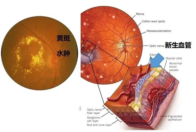 图1：糖尿病相关的黄斑水肿、新生血管