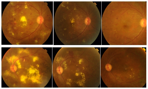 图5 联合治疗效果不错的病例