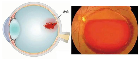 图2 糖尿病相关的玻璃体积血