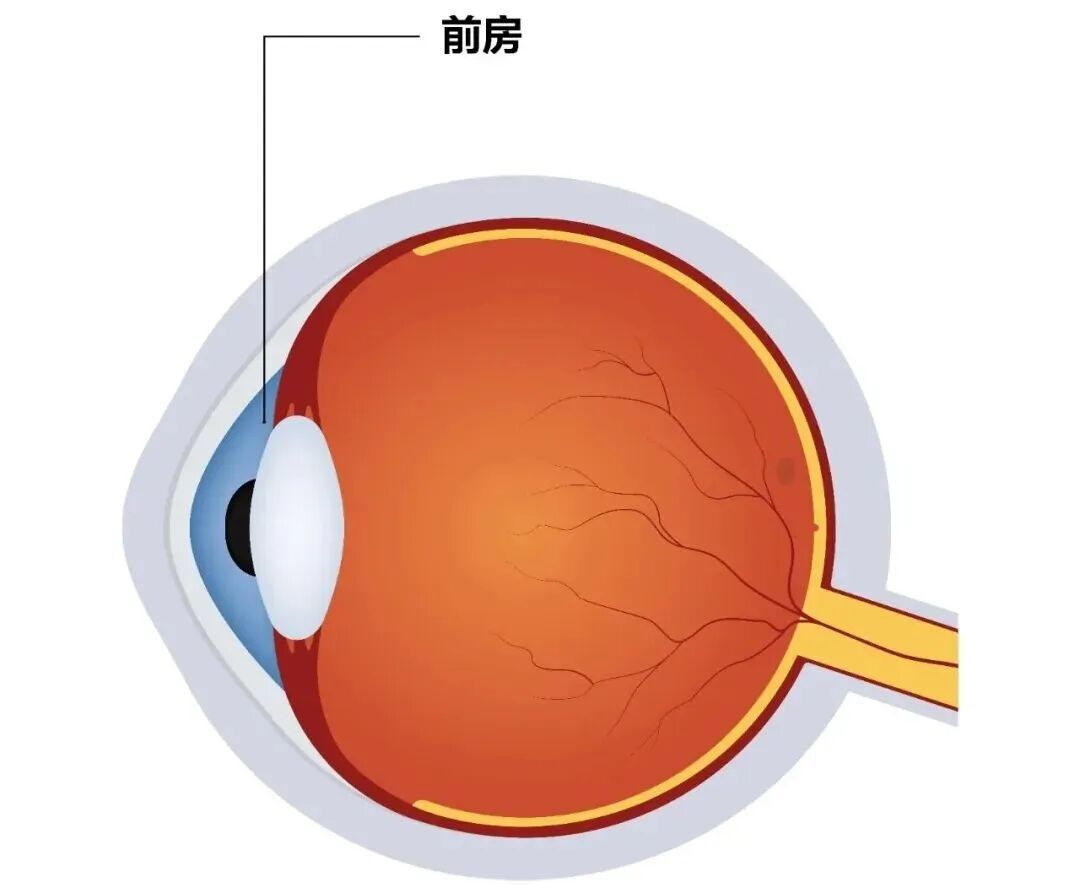 前房深度:得“放得进晶体”
