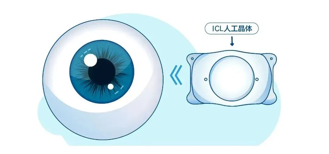 ICL晶体植入术