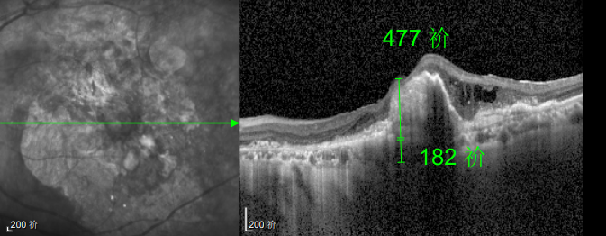 △延误复查后的左眼