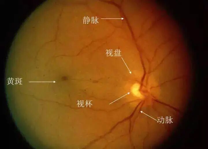 高度近视往往会发展为病理性近视
